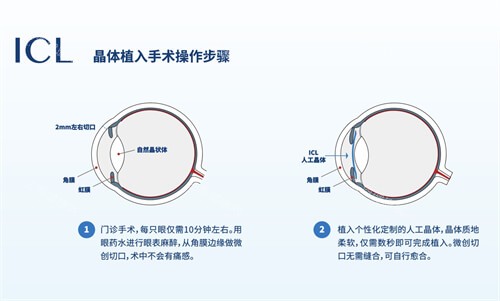 icl晶體植入術(shù)手術(shù)步驟漫畫圖