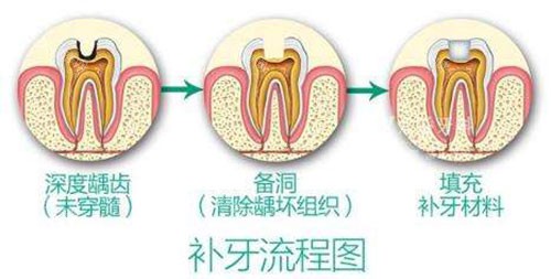 補(bǔ)牙流程圖示意圖