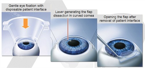 2025愛爾眼科收費(fèi)價(jià)目表出爐！近視手術(shù)8000元起，白內(nèi)障、OK鏡、斜視手術(shù)等價(jià)格透明